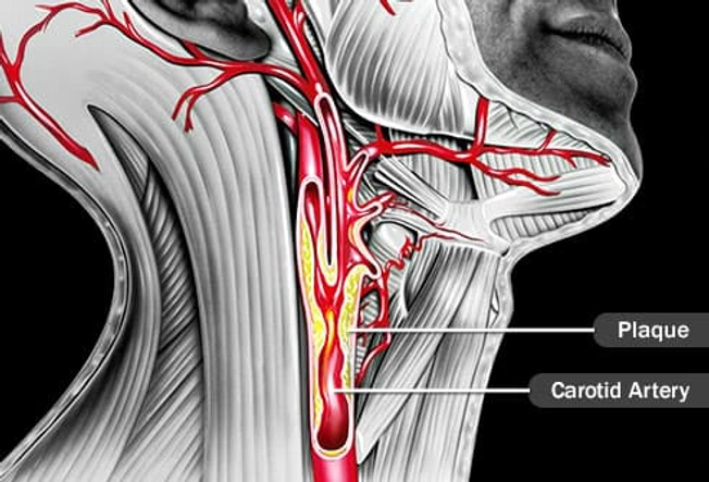 Carotid Artery Disease