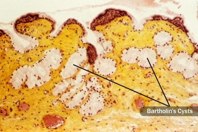 Bartholin's Cyst