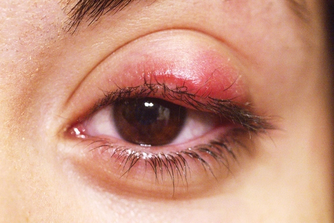 Chalazion