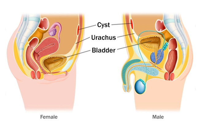 Urachal Cyst