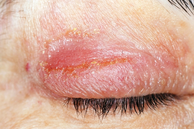 Eczema and Infections