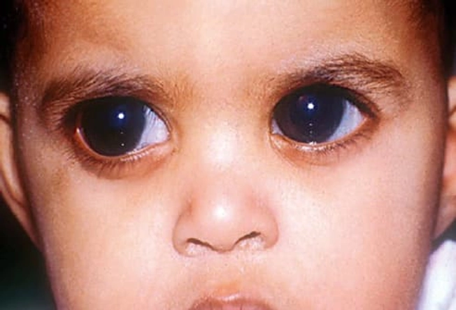 Types of Glaucoma: Congenital