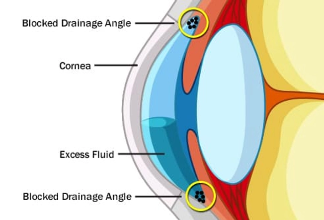 What Causes Glaucoma?