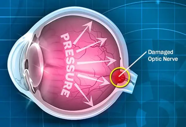 What Is Glaucoma?