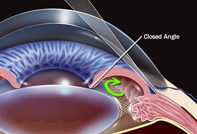 Types of Glaucoma: Angle-Closure