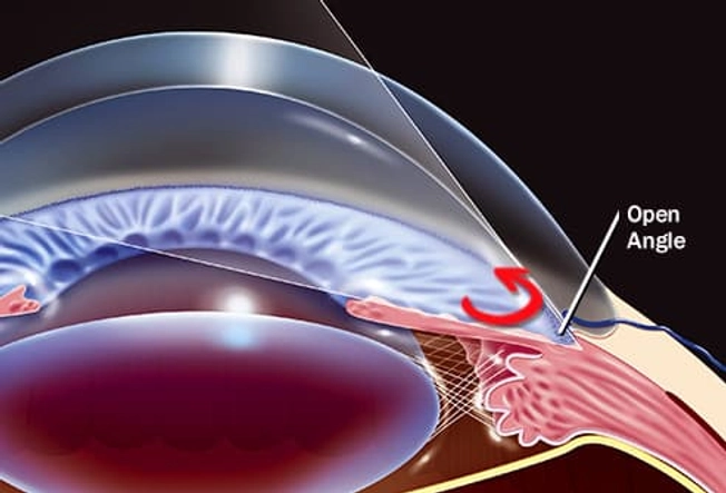 Types of Glaucoma: Open-Angle