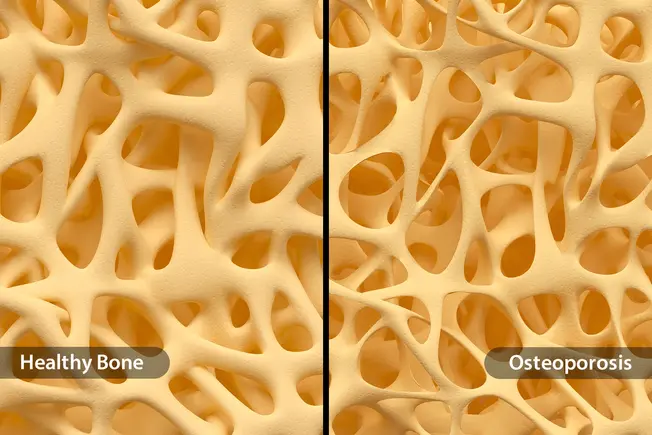 What Is Osteoporosis?