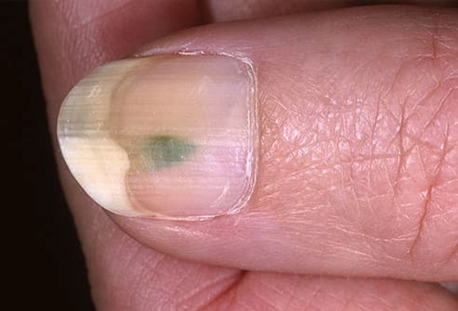 Discolored Nails