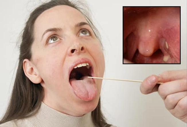 Tonsil Stones