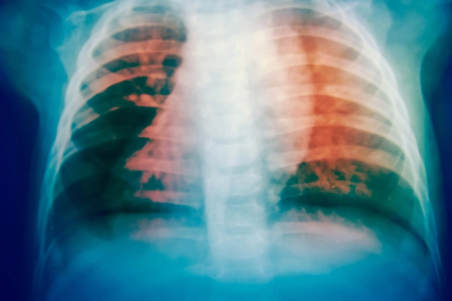 Tuberculosis