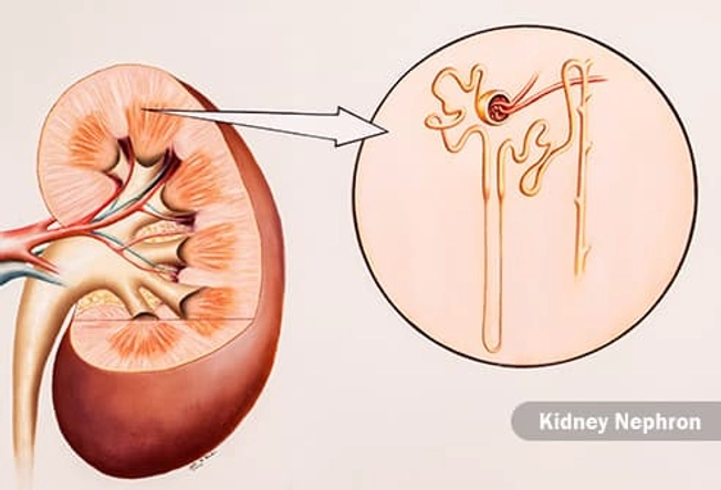 Kidney Failure