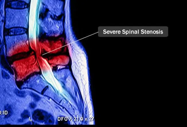 Visual Guide To Spinal Stenosis visual-guide-to-spinal-stenosis