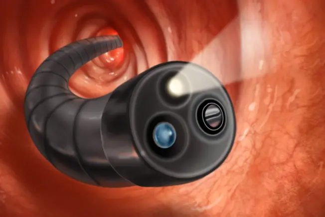 What Is a Colonoscopy?