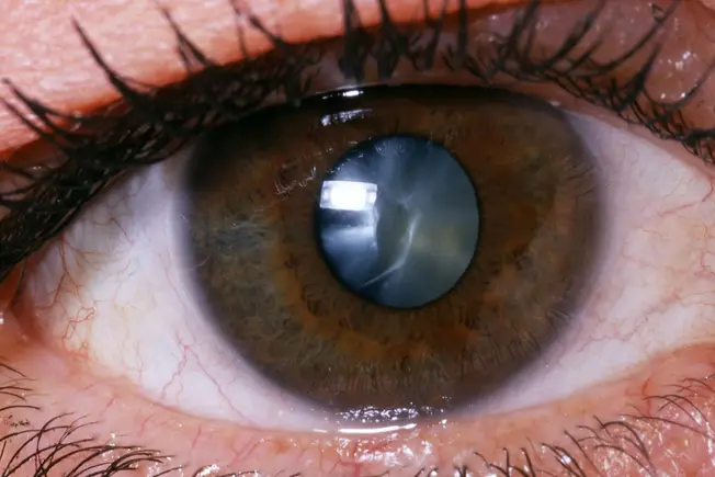 What Is a Cataract?