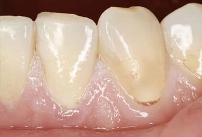 Pale Gums and Anemia