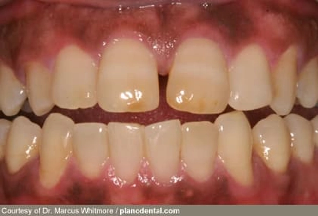 Gum Disease and Diabetes