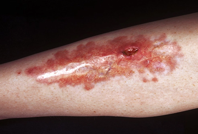 Leg Plaque: Red on Edge, Gold in Center