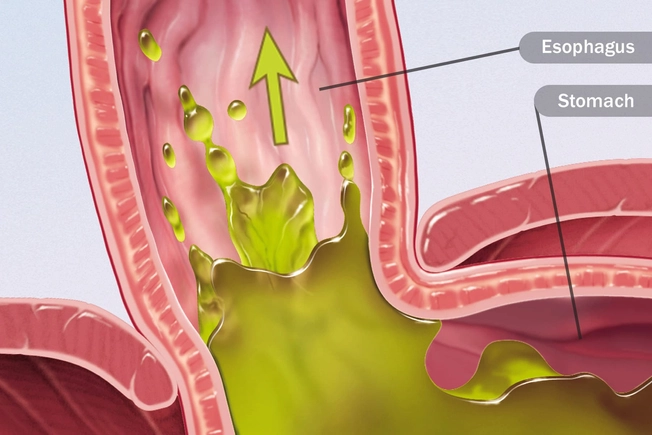 Acid Reflux
