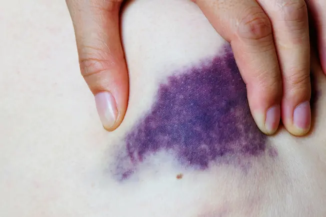 What Is a Bruise?