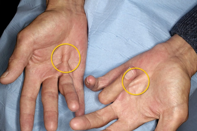Dupuytren's Contracture