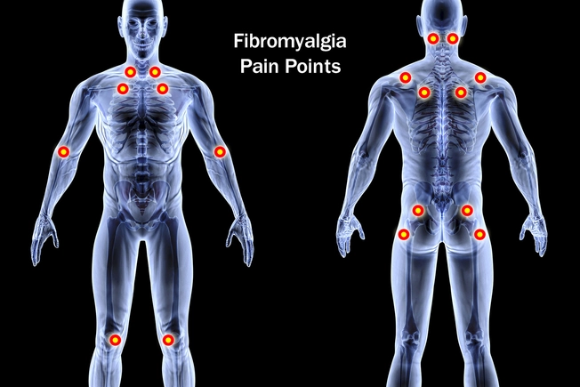 Fibromyalgia
