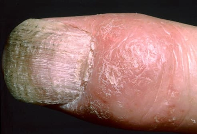 Psoriatic Arthritis (PsA)