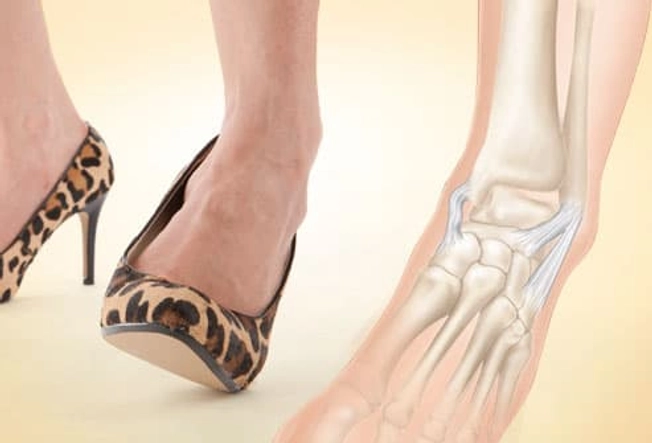 Problem: Ankle Sprains