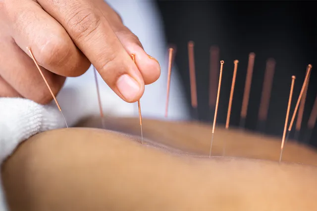 Parallel Paths: Acupuncture and Crohn’s
