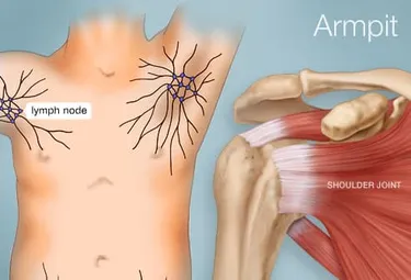 The armpit, or axilla, has more than 20 lymph nodes -- small lumps of tissue that are part of the body's lymphatic system, which helps fight infection. (Photo credit: WebMD)