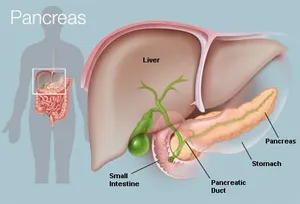In pancreatitis, the pancreas becomes inflamed and damaged by its own digestive chemicals. Swelling and death of tissue of the pancreas can result. 