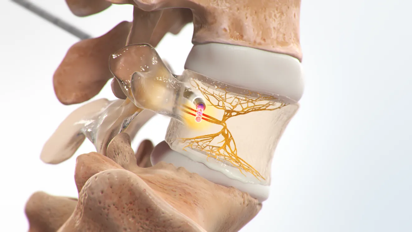 WebMD - Intracept Procedure